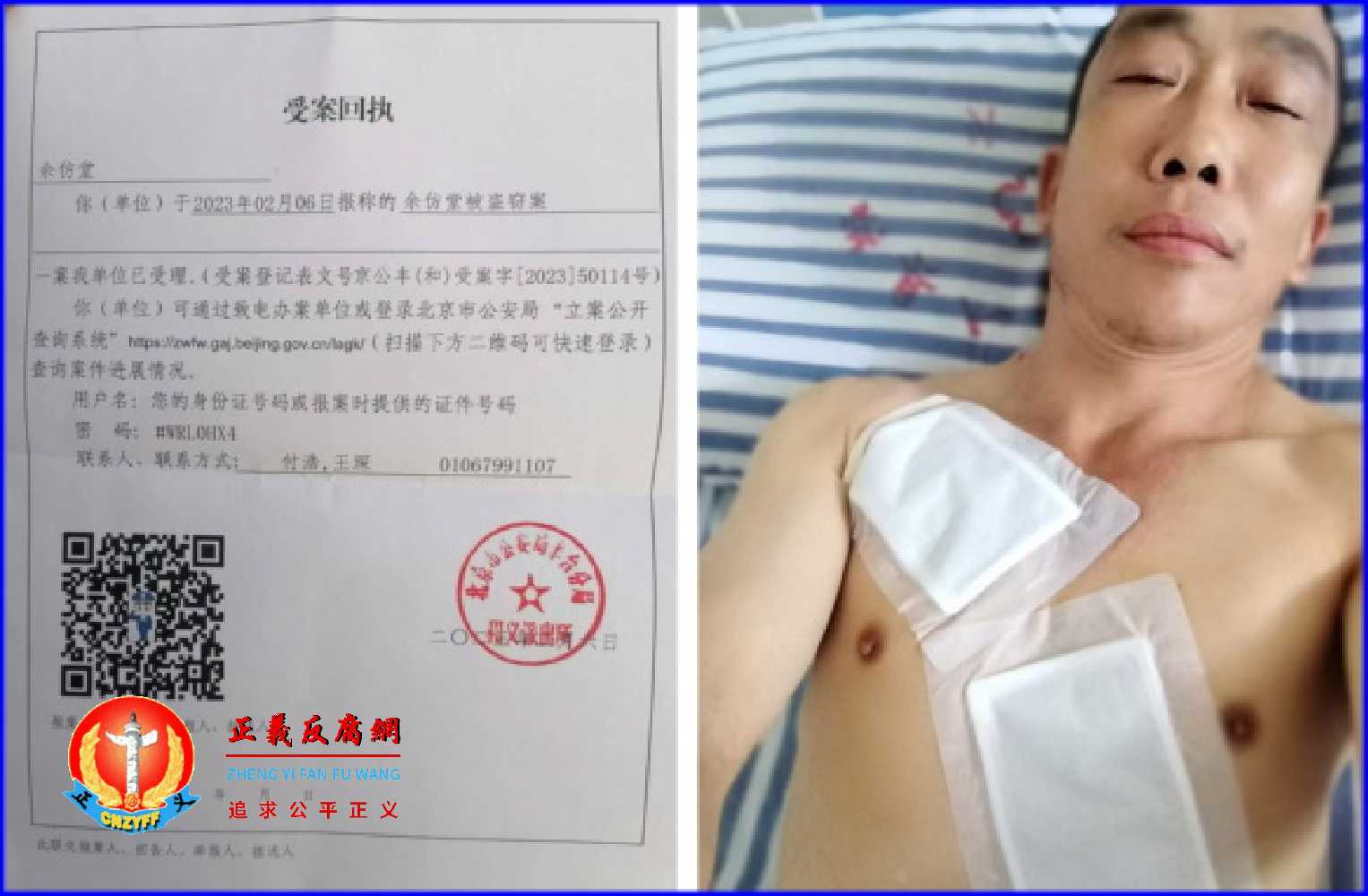 四川珙县访民余仿堂,因为被地方政府雇用监控他的人殴打,导致骨折住院。.jpg 四川珙县访民余仿堂,因为被地方政府雇用监控他的人殴打,导致骨折住院。.jpg